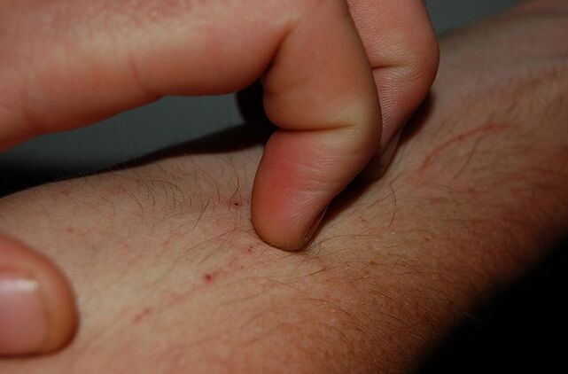 φαγούρα στο δέρμα ως σύμπτωμα της παρουσίας παρασίτων